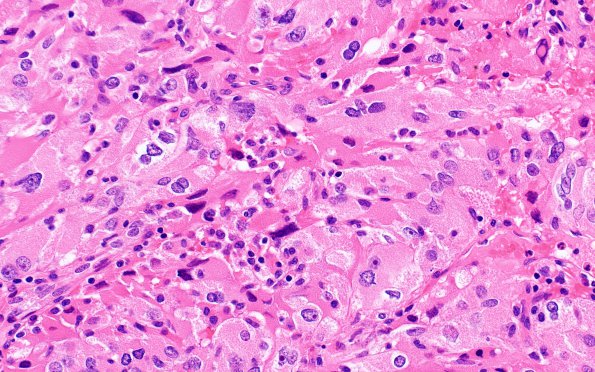 1C7 Spindle cell Oncocytoma (Case 1) H&E 8