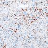 1D1 Spindle cell Oncocytoma (Case 1) TTF1 1