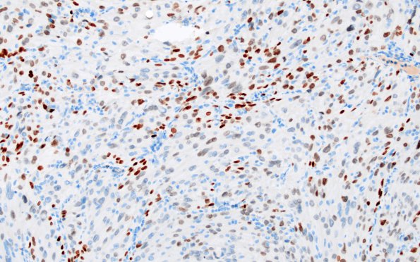 1D1 Spindle cell Oncocytoma (Case 1) TTF1 1