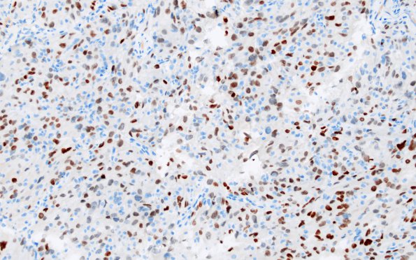 1D2 Spindle cell Oncocytoma (Case 1) TTF1 3