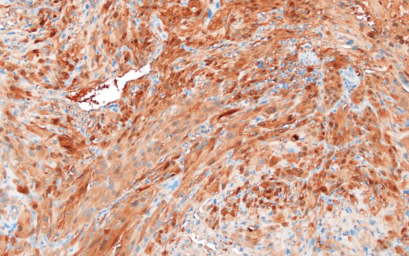 1F1 Spindle cell Oncocytoma (Case 1) S100 2