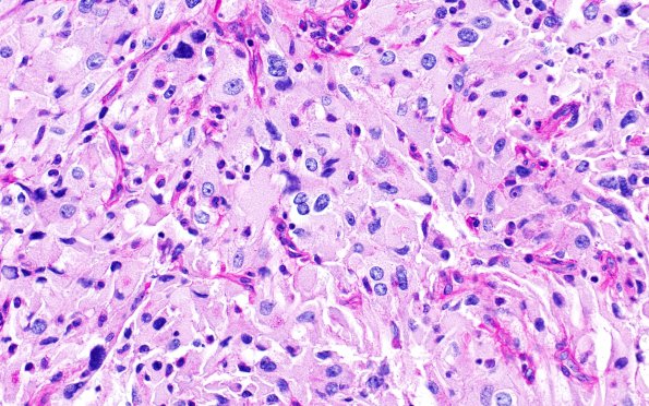 1G Spindle cell Oncocytoma (Case 1) PAS 1