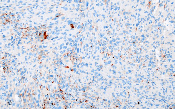 1H Spindle cell Oncocytoma (Case 1) EMA 1