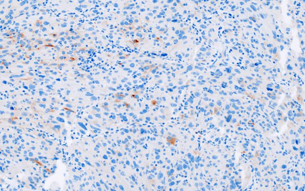 1J Spindle cell Oncocytoma (Case 1) SYN 1