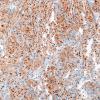 1K1 Spindle cell Oncocytoma (Case 1) TTF1