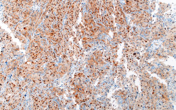 1K1 Spindle cell Oncocytoma (Case 1) TTF1