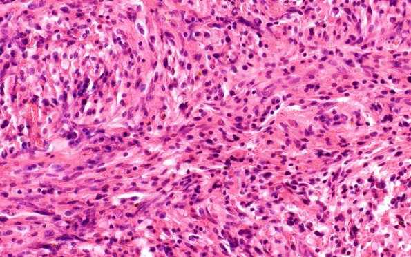 2A2 Spindle cell Oncocytoma (Case 2) H&E 1