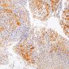 2B1 Spindle cell Oncocytoma (Case 2) S100 1