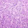 3A3 Spindle cell oncocytoma (Case 3) H&E 4