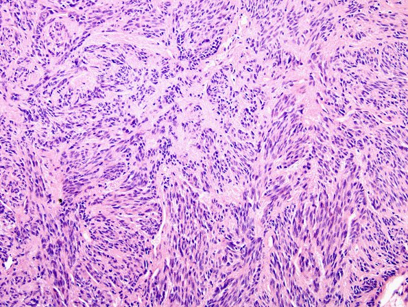 3A3 Spindle cell oncocytoma (Case 3) H&E 4