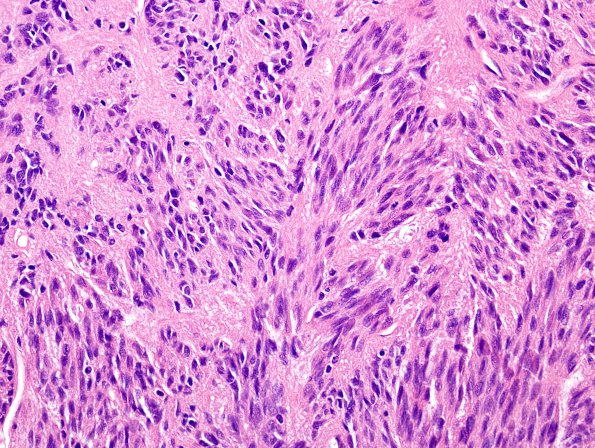 3A4 Spindle cell oncocytoma (Case 3) H&E 3