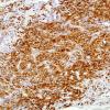 3B1 Spindle Cell Oncocytoma (Case 3) S100 6