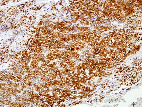 3B1 Spindle Cell Oncocytoma (Case 3) S100 6