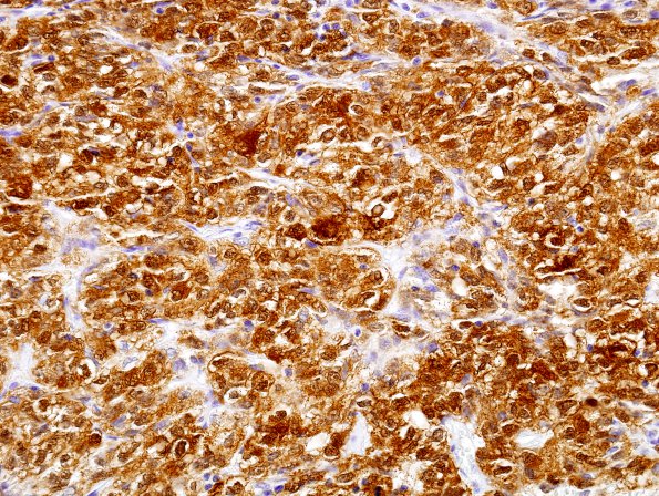 3B2 Spindle Cell Oncocytoma (Case 3) S100 7