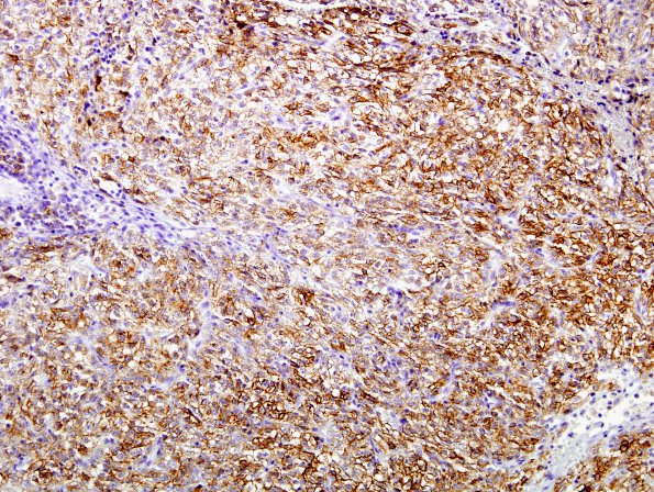 3C1 Spindle cell oncocytoma (Case 3) EMA 3