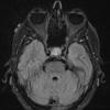 4A1 Spindle cell oncocytoma (Case 4) FLAIR - Copy