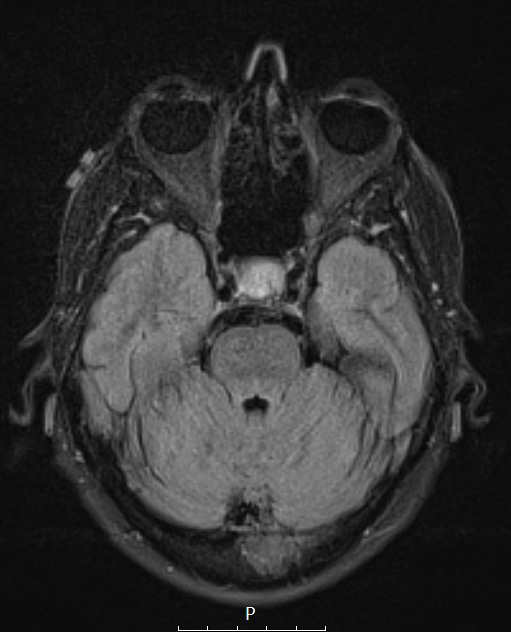 4A1 Spindle cell oncocytoma (Case 4) FLAIR - Copy