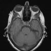 4A2 Spindle cell oncocytoma (Case 4) T1 noC - Copy