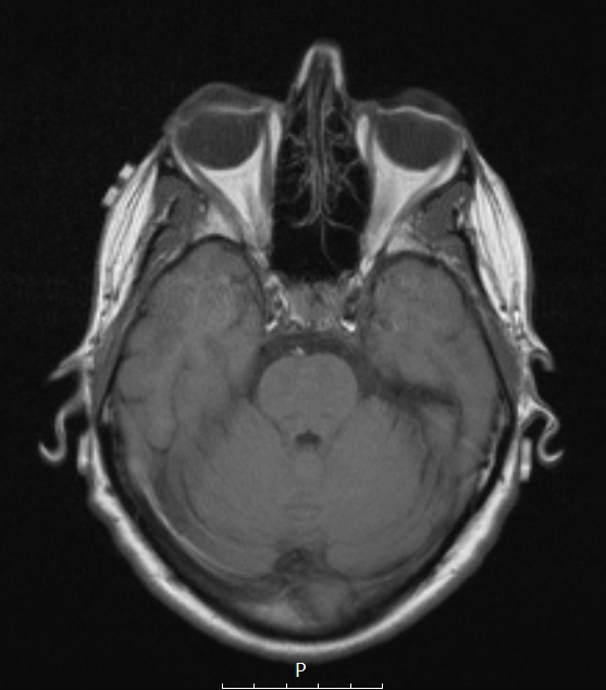 4A2 Spindle cell oncocytoma (Case 4) T1 noC - Copy