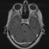 4A3A Spindle cell oncocytoma (Case 4) T1W - Copy