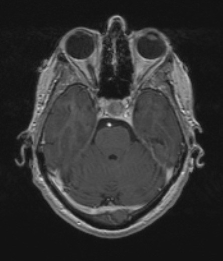 4A3A Spindle cell oncocytoma (Case 4) T1W - Copy