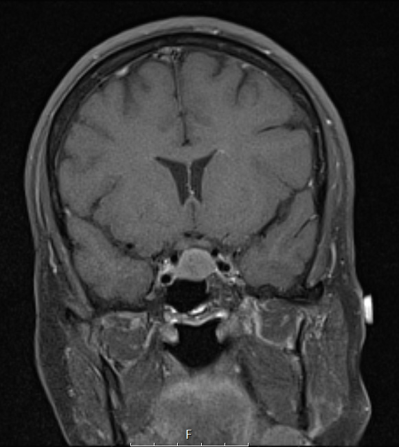 4A3B Spindle cell oncocytoma (Case 4) T1W COR - Copy