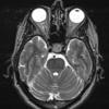 4A4 Spindle cell oncocytoma (Case 4) T2W - Copy