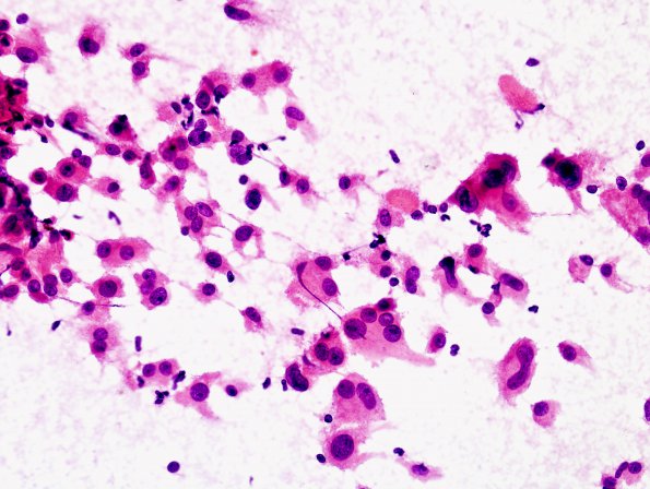 4B1 Spindle cell oncocytoma (Case 4) Smear 1