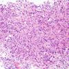 4B2 Spindle cell oncocytoma (Case 4) H&E 4