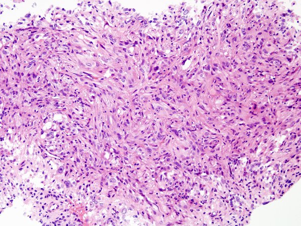 4B2 Spindle cell oncocytoma (Case 4) H&E 4