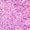 4B3 Spindle cell oncocytoma (Case 4) H&E 3