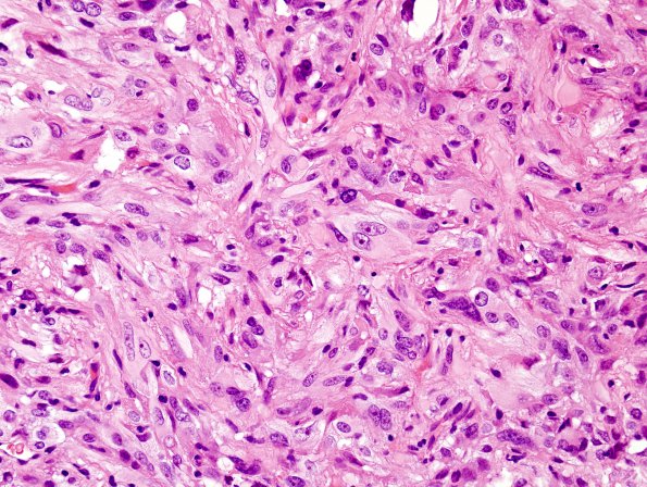 4B3 Spindle cell oncocytoma (Case 4) H&E 3