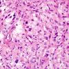 4B4 Spindle cell oncocytoma (Case 4) H&E 7