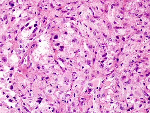 4B4 Spindle cell oncocytoma (Case 4) H&E 7