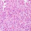 4B6 Spindle cell oncocytoma (Case 4) H&E 12