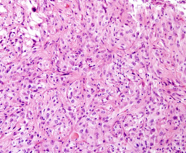 4B6 Spindle cell oncocytoma (Case 4) H&E 12