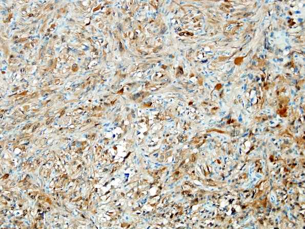 4C1 Spindle cell oncocytoma (Case 4) S100 4