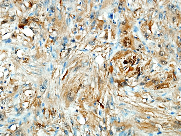 4C2 Spindle cell oncocytoma (Case 4) S100 2