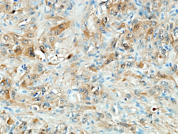 4C3 Spindle cell oncocytoma (Case 4) S100 5