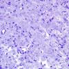 4D1 Spindle cell oncocytoma (Case 4) Plastic 3