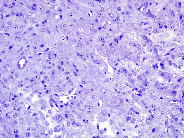 4D1 Spindle cell oncocytoma (Case 4) Plastic 3