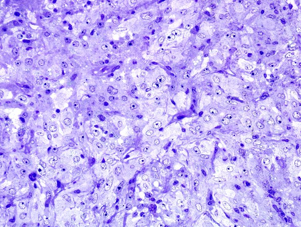 4D2 Spindle cell oncocytoma (Case 4) Plastic 1