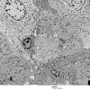 4E1 Spindle Cell Oncocytoma (Case 4) EM 010 - Copy