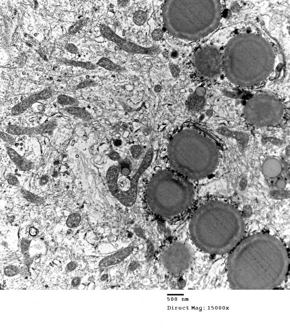 4E11 Spindle Cell Oncocytoma (Case 4) EM 037 - Copy