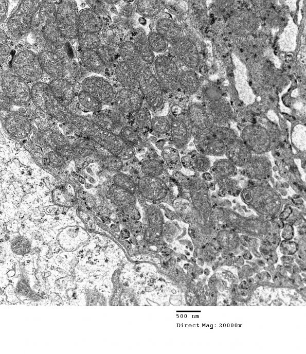 4E3 Spindle Cell Oncocytoma (Case 4) EM 013 - Copy