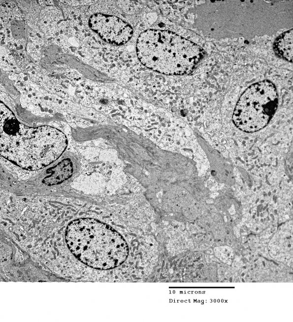 4E4 Spindle Cell Oncocytoma (Case 4) EM 016 - Copy