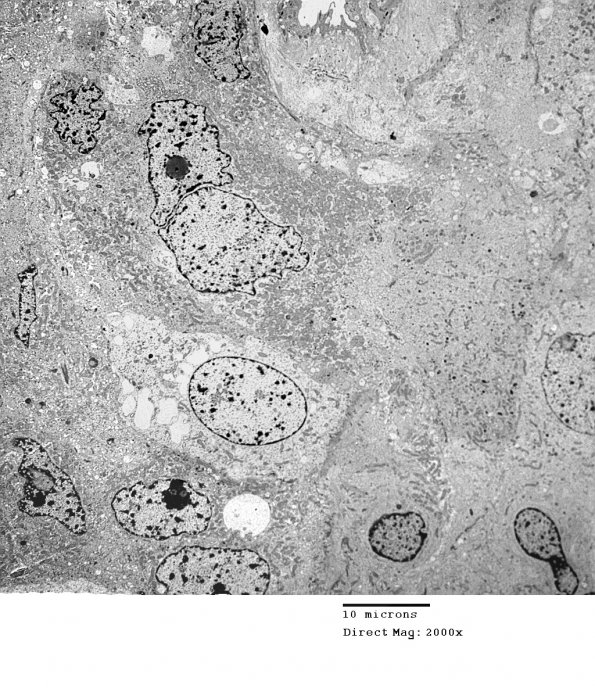 4E5 Spindle Cell Oncocytoma (Case 4) EM 031 - Copy