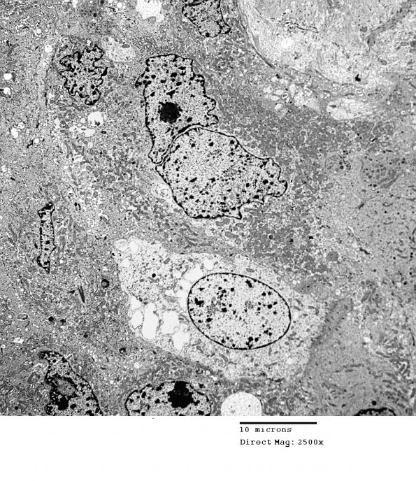 4E6 Spindle Cell Oncocytoma (Case 4) EM 032 - Copy