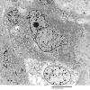 4E7 Spindle Cell Oncocytoma (Case 4) EM 033 - Copy