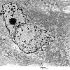 4E8 Spindle Cell Oncocytoma (Case 4) EM 034 - Copy - Copy